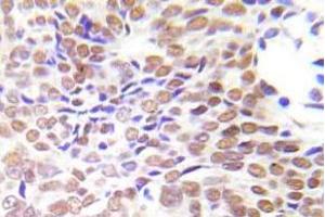 Immunohistochemistry (IHC)analyzes of HDAC1 antibody in paraffin-embedded human lung adenocarcinoma tissue. (HDAC1 Antikörper)