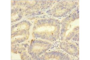 Immunohistochemistry of paraffin-embedded human endometrial cancer using ABIN7166030 at dilution of 1:100 (S1A1 (AA 2-94) Antikörper)