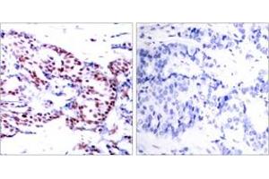Immunohistochemistry analysis of paraffin-embedded human breast carcinoma tissue, using ATF2 (Ab-71 or 53) Antibody. (ATF2 Antikörper  (AA 38-87))