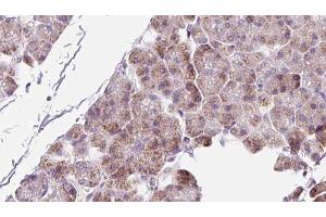 ABIN6273223 at 1/100 staining Human pancreas cancer tissue by IHC-P.