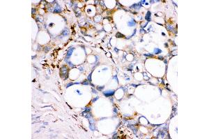Anti- GPX1 antibody, IHC(P) IHC(P): Human Intestinal Cancer Tissue (Glutathione Peroxidase 1 Antikörper  (Middle Region))