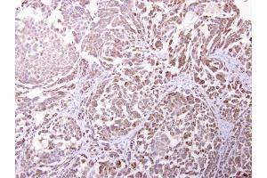 IHC-P Image Endomucin antibody [N1C2] detects Endomucin protein at cytosol on human lung carcinoma by immunohistochemical analysis. (Endomucin Antikörper)