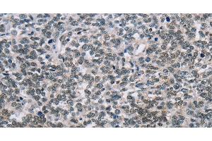 Immunohistochemistry of paraffin-embedded Human ovarian cancer tissue using TONSL Polyclonal Antibody at dilution 1:60