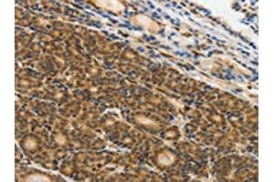 The image on the left is immunohistochemistry of paraffin-embedded Human thyroid cancer tissue using ABIN7130641(PIWIL4 Antibody) at dilution 1/25, on the right is treated with fusion protein.