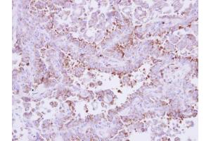 IHC-P Image Immunohistochemical analysis of paraffin-embedded human lung cancer, using Laminin beta 3, antibody at 1:250 dilution. (Laminin beta 3 Antikörper)