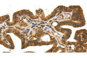 Immunohistochemistry of paraffin-embedded Human thyroid cancer using STX11 Polyclonal Antibody at dilution of 1:30 (Syntaxin 11 Antikörper)