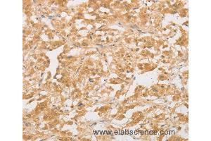 Immunohistochemistry of Human colon cancer using CD24 Polyclonal Antibody at dilution of 1:40