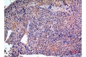 Immunohistochemistry (IHC) analysis of paraffin-embedded Human Liver Cancer, antibody was diluted at 1:100. (SCCA1/2 (Internal Region) Antikörper)