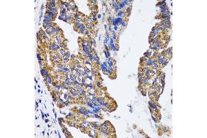 Immunohistochemistry of paraffin-embedded human gastric cancer using TP53 antibody (ABIN5973383) at dilution of 1/100 (40x lens). (p53 Antikörper)