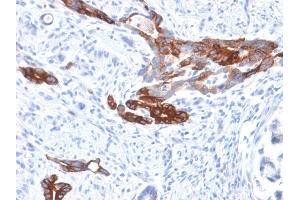 Formalin-fixed, paraffin-embedded human Gastric Carcinoma stained with MUC6 Rabbit Recombinant Monoclonal Antibody (MUC6/1553R). (Rekombinanter MUC6 Antikörper)