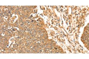 Immunohistochemistry of paraffin-embedded Human lung cancer using ERK 5 Polyclonal Antibody at dilution of 1:35 (MAPK7 Antikörper)