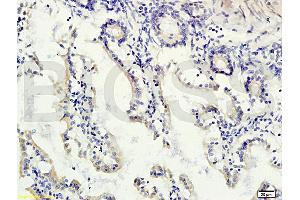 Formalin-fixed and paraffin embedded human colon carcinoma labeled with Rabbit Anti-gremlin Polyclonal Antibody (ABIN687082) at 1:200 followed by conjugation to the secondary antibody and DAB staining.