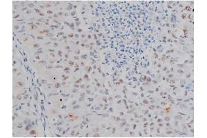ABIN6267230 at 1/200 staining Human lung cancer tissue sections by IHC-P. (IKK-alpha /IKK-beta Antikörper  (pSer180, pSer181))