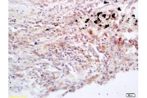 Formalin-fixed and paraffin embedded human lung carcinoma labeled with Rabbit Anti Jak3 Polyclonal Antibody, Unconjugated (ABIN681013) at 1:200 followed by conjugation to the secondary antibody and DAB staining (JAK3 Antikörper  (AA 601-700))