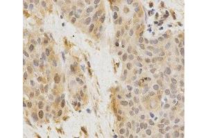 Immunohistochemistry of paraffin-embedded Human esophageal cancer using GGA2 Polyclonal Antibody at dilution of 1:200 (40x lens).