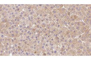 ABIN6273362 at 1/100 staining Human Melanoma tissue by IHC-P. (LDHAL6A Antikörper  (Internal Region))