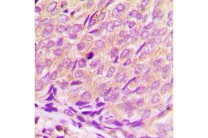 Immunohistochemical analysis of Histone Deacetylase 3 staining in human breast cancer formalin fixed paraffin embedded tissue section. (HDAC3 Antikörper  (C-Term))