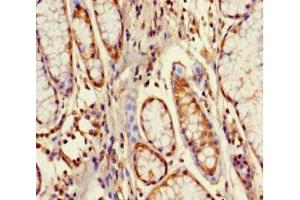 Immunohistochemistry of paraffin-embedded human gastric cancer using ABIN7164529 at dilution of 1:100 (GPX8 Antikörper  (AA 41-209))