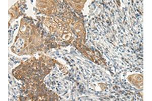 The image on the left is immunohistochemistry of paraffin-embedded Human cervical cancer tissue using ABIN7193020(VIPR2 Antibody) at dilution 1/35, on the right is treated with synthetic peptide. (VIPR2 Antikörper)
