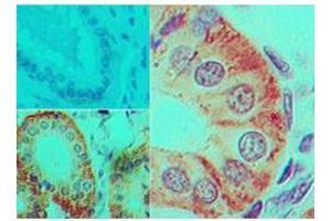 Immunohistochemistry of Mouse Anti-IL-17F antibody Tissue: human colon tissue Fixation: formalin-fixed, paraffin-embedded Primary antibody: isotype control (top left) , Mouse Anti-IL-17F antibody (bottom left, right) at 5 ug/ml (IL17F Antikörper)