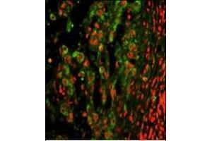 Immunofluorescence analysis of ITGAX Antibody (C-term) with paraffin-embedded human hepatocarcinoma. (CD11c Antikörper  (C-Term))