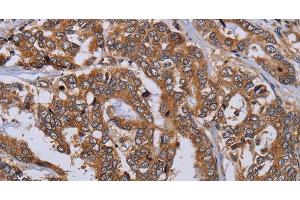 Immunohistochemistry of paraffin-embedded Human liver cancer tissue using MFAP3L Polyclonal Antibody at dilution 1:50