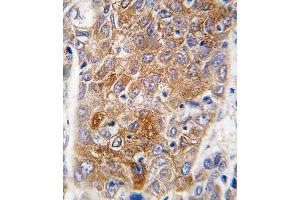 Formalin-fixed and paraffin-embedded human hepatocarcinoma tissue reacted with ALDH1L1 antibody (C-term), which was peroxidase-conjugated to the secondary antibody, followed by DAB staining. (ALDH1L1 Antikörper  (C-Term))