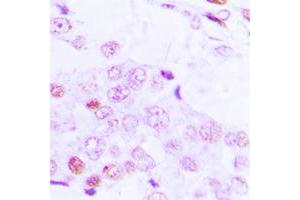 Immunohistochemical analysis of ATF2 (pT69) staining in human lung cancer formalin fixed paraffin embedded tissue section.