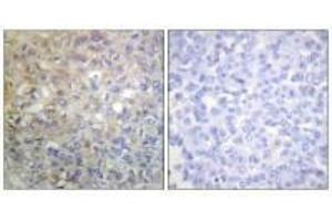 Immunohistochemistry analysis of paraffin-embedded human breast carcinoma tissue using FGFR1 (Ab-766) antiobdy. (FGFR1 Antikörper  (Tyr766))