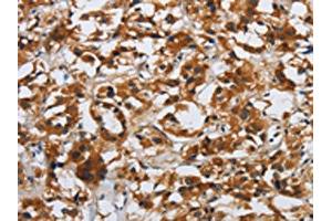 The image on the left is immunohistochemistry of paraffin-embedded Human thyroid cancer tissue using ABIN7190509(DSP Antibody) at dilution 1/40, on the right is treated with synthetic peptide. (Desmoplakin Antikörper)
