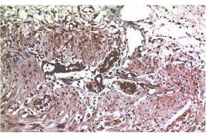 Immunohistochemistry of paraffin-embedded Human colon carcinoma tissue using MMP2 Monoclonal Antibody at dilution of 1:200. (MMP2 Antikörper)
