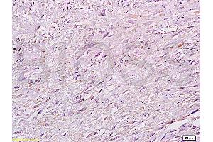 Formalin-fixed and paraffin: human cervical carcinoma labeled with Anti-RB1CC1 Polyclonal Antibody (ABIN872758), Unconjugated at 1:200 followed by conjugation to the secondary antibody and DAB staining (FIP200 Antikörper  (AA 501-600))
