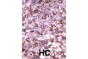 Formalin-fixed and paraffin-embedded human hepatocellular carcinoma tissue reacted with MAGEL2 polyclonal antibody  , which was peroxidase-conjugated to the secondary antibody, followed by DAB staining. (MAGE-Like 2 Antikörper  (C-Term))
