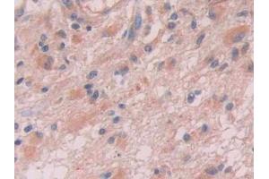 DAB staining on IHC-P; Samples: Human Glioma Tissue (Anion/Sugar Transporter Antikörper  (AA 146-405))