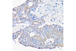 Immunohistochemistry of paraffin-embedded Human colon carcinoma using  Rabbit pAb (ABIN7265368) at dilution of 1:100 (40x lens). (ACAA2 Antikörper  (AA 1-250))