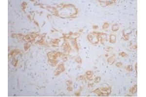 Immunohistochemistry (IHC) staining of Human Breast cancer tissue, diluted at 1:200. (beta Catenin Antikörper)