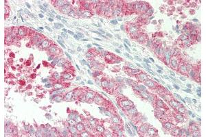 Rabbit Anti-HBEGF antibody Catalog Number: ARP45201 Formalin Fixed Paraffin Embedded Tissue: Human Uterus Primary antibody Concentration: 1:100 Secondary Antibody: Donkey anti-Rabbit-Cy3 Secondary Antibody Concentration: 1:200 Magnification: 20x Exposure Time: 0. (HBEGF Antikörper  (N-Term))