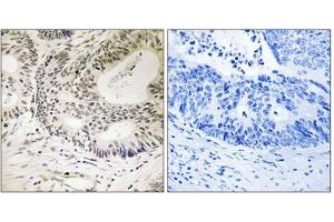 Immunohistochemical staining of paraffin-embedded human colon carcinoma tissue reacted with TP53BP1 (phospho S25) polyclonal antibody  at 1:50-1:100 dilution. (TP53BP1 Antikörper  (pSer25))