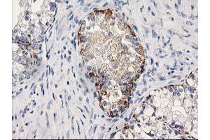 Immunohistochemical staining of paraffin-embedded Adenocarcinoma of Human ovary tissue using anti-MGLL mouse monoclonal antibody. (MGLL Antikörper)