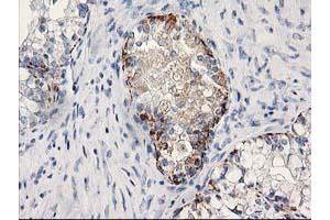 Immunohistochemical staining of paraffin-embedded Adenocarcinoma of Human ovary tissue using anti-MGLL mouse monoclonal antibody.