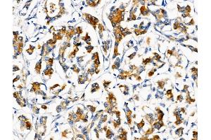 ABIN6259059 and ABIN6274712 at 1/100 staining Human pancreatic cancer and adjacent nomal tissues by IHC-P.