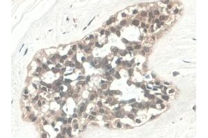 DAB staining on IHC-P; Samples: Human Pancreatic cancer Tissue)