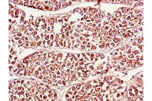 Immunohistochemistry of paraffin-embedded human liver cancer using ABIN7165275 at dilution of 1:100 (PDIA4 Antikörper  (AA 101-400))
