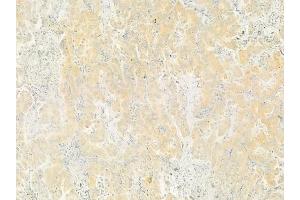 ABIN6264204 and ABIN6279655 at 1/100 staining human lung adenocarcinoma by IHC-P.