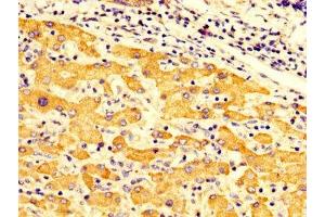 IHC image of ABIN7149956 diluted at 1:300 and staining in paraffin-embedded human liver cancer performed on a Leica BondTM system. (FMO3 Antikörper  (AA 111-219))