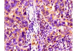 Immunohistochemistry of paraffin-embedded human pancreatic cancer using ABIN7148403 at dilution of 1:100 (Complement Factor I Antikörper  (AA 239-316))