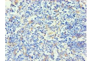 Immunohistochemistry of paraffin-embedded human cervical cancer using ABIN7157384 at dilution of 1:100 (KRT14 Antikörper  (AA 1-472))