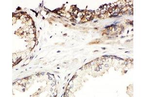 IHC-P: Kallikrein-11 antibody testing of human prostatic cancer tissue (Kallikrein 11 Antikörper  (C-Term))
