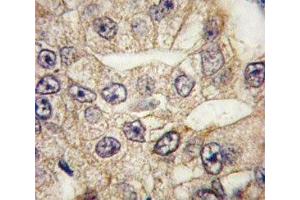 IHC analysis of FFPE human lung carcinoma tissue stained with CD14 antibody (CD14 Antikörper  (AA 54-83))
