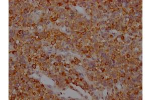IHC image of ABIN7127835 diluted at 1:100 and staining in paraffin-embedded human glioma cancer performed on a Leica BondTM system. (Rekombinanter MAPT Antikörper)